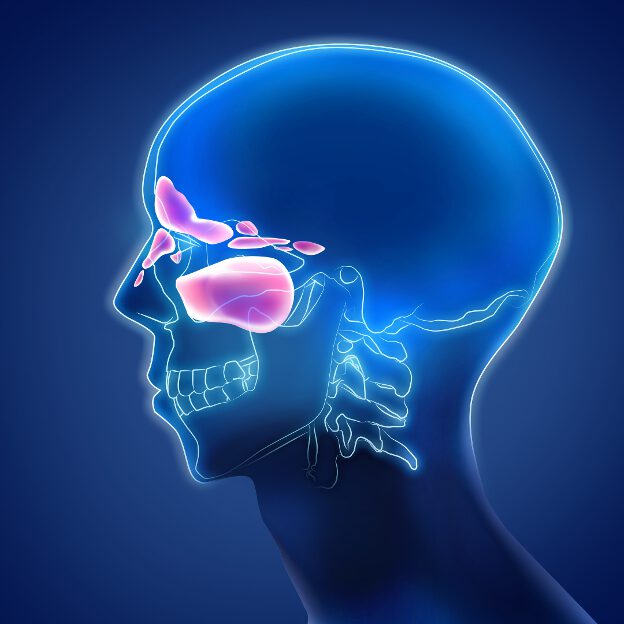 Sinusitis
